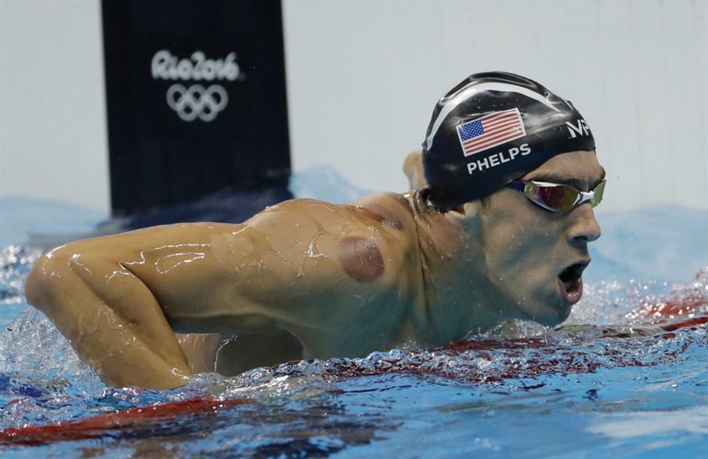 Olympic swimmer Michael Phelps with round purple cupping marks on his shoulder while competing at the 2016 Rio Olympics, the moment that pushed cupping into the mainstream.